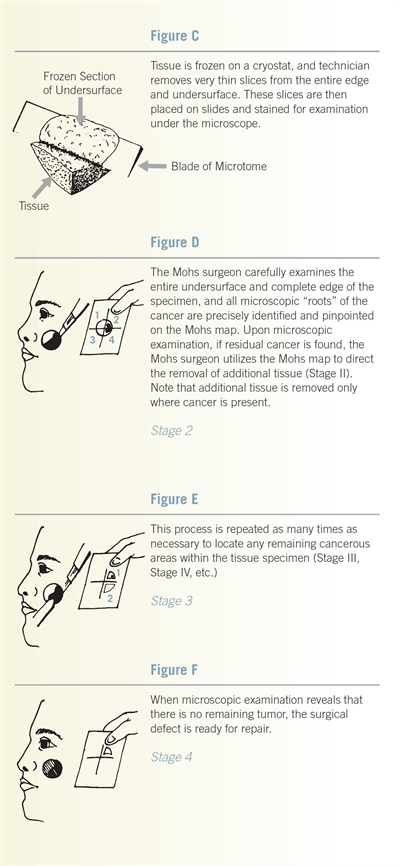 Mohs Surgery 34952