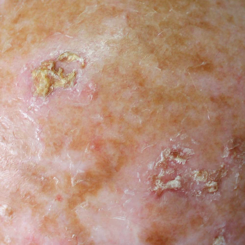 Actinic Keratosis Pictures