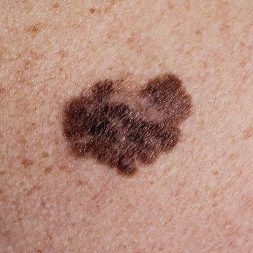 Melanoma