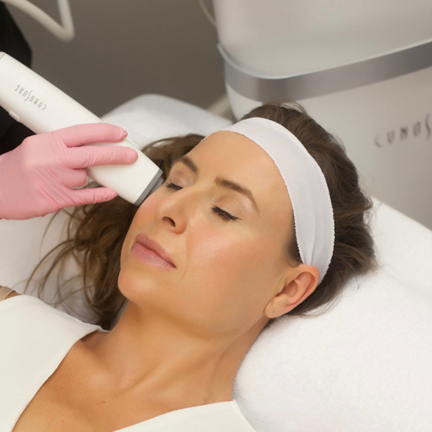 RF Microneedling