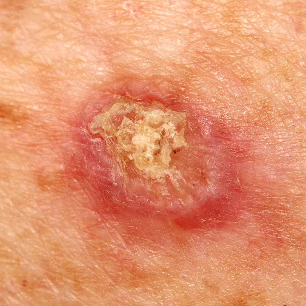 squamous cell carcinoma