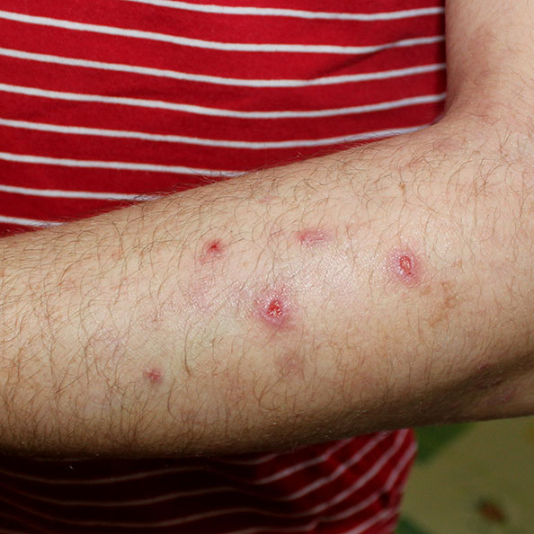 Prurigo nodularis