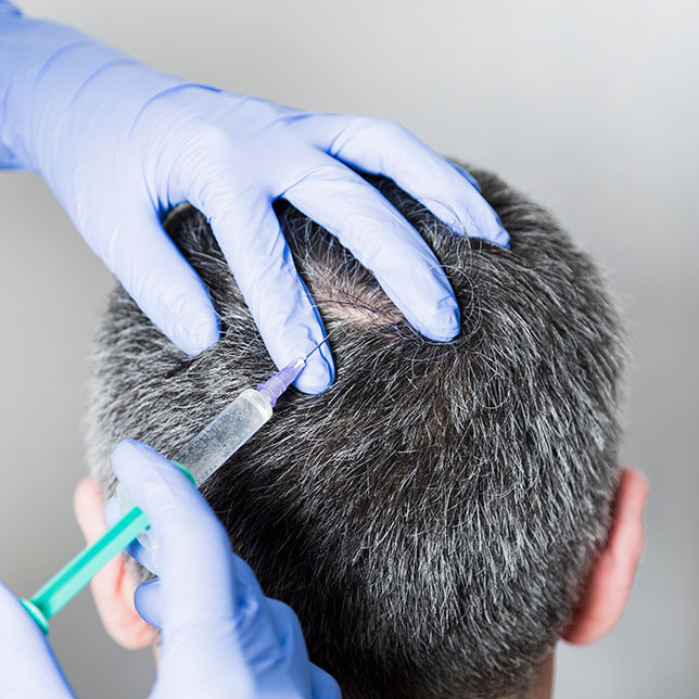 Alopecia