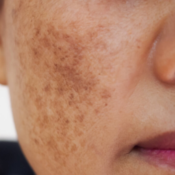 Melasma