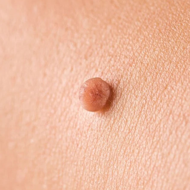 Skin tags
