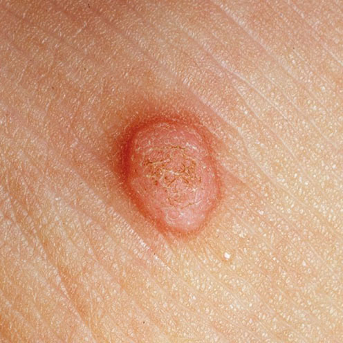 wart