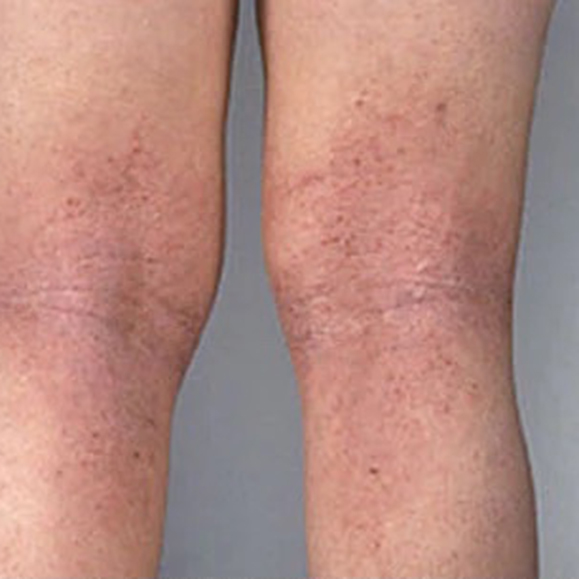 atopic dermatitis