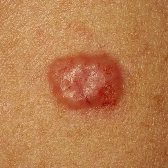 basal cell carcinoma
