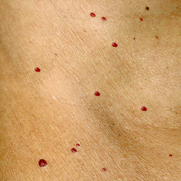cherry angioma