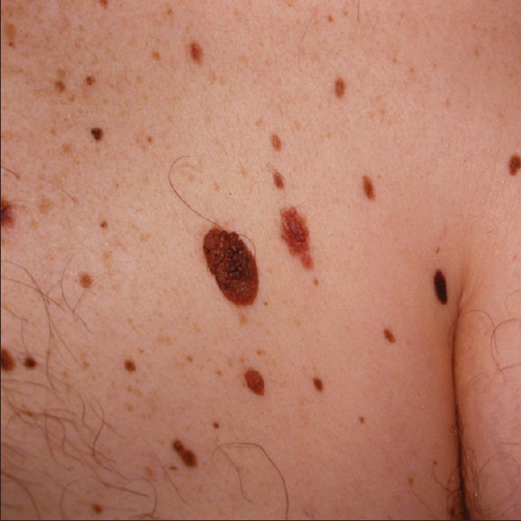 dysplastic nevus