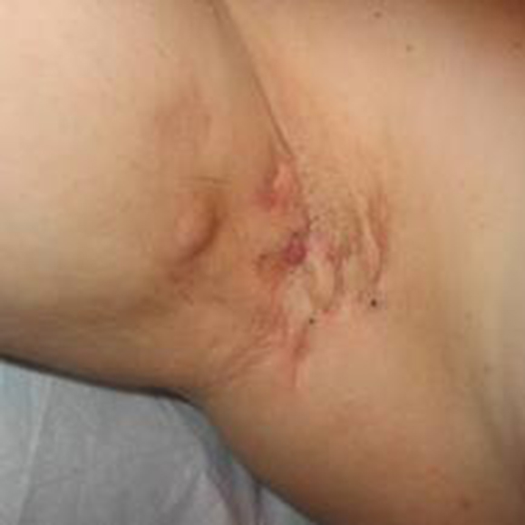 hidradenitis suppurativa
