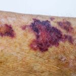 Bruising Rash Purpura/superficial bruises - Cynthia Rogers, MD