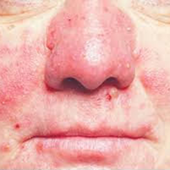 rosacea