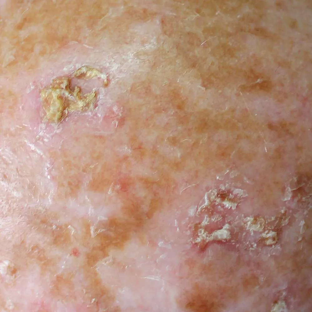 Actinic keratosis