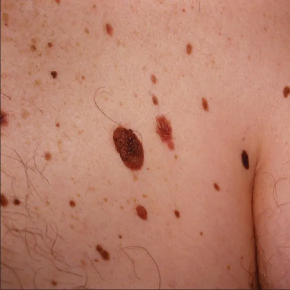 dysplastic nevus