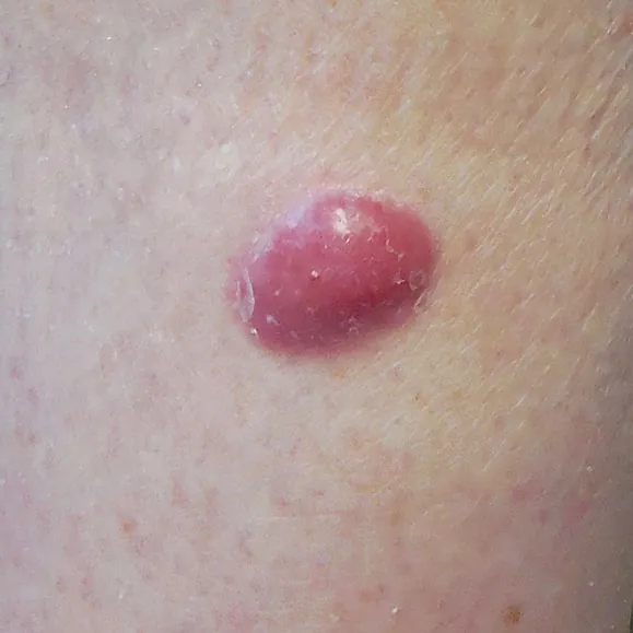 merkel cell carcinoma