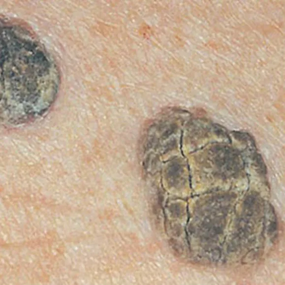 seborrheic keratosis